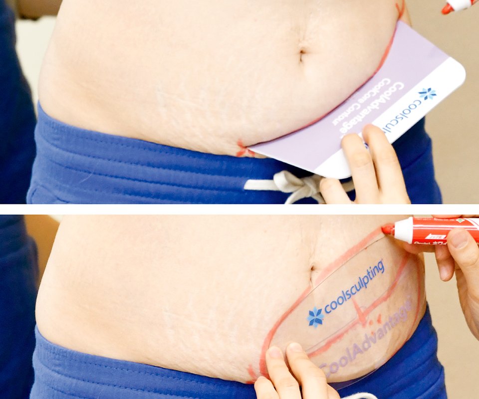 アセスメント（マーキング）